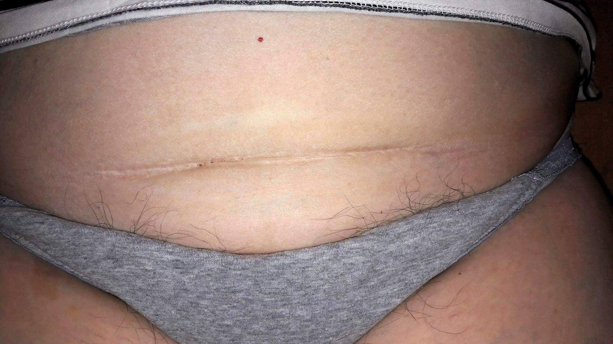 Läkare behöver verkligen lära sig om ärr