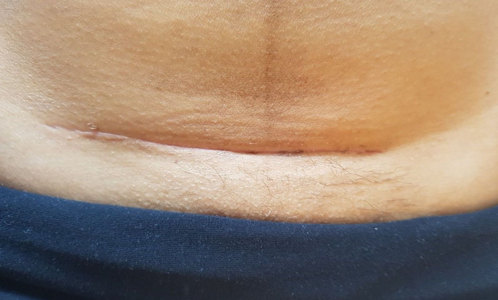 MSTR® och kejsarsnittsärr