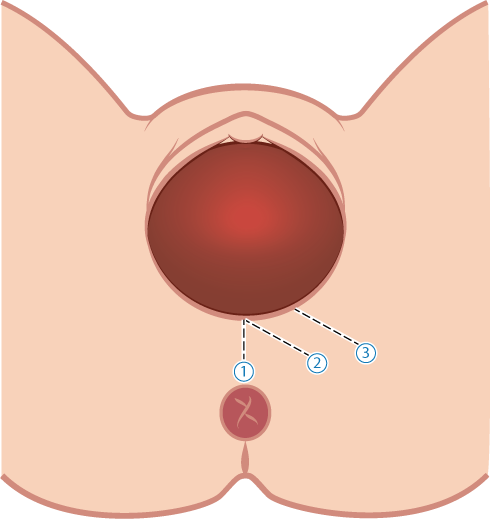 Ärr från vaginal förlossning